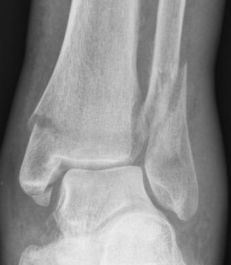 X-ray of an Ankle fracture